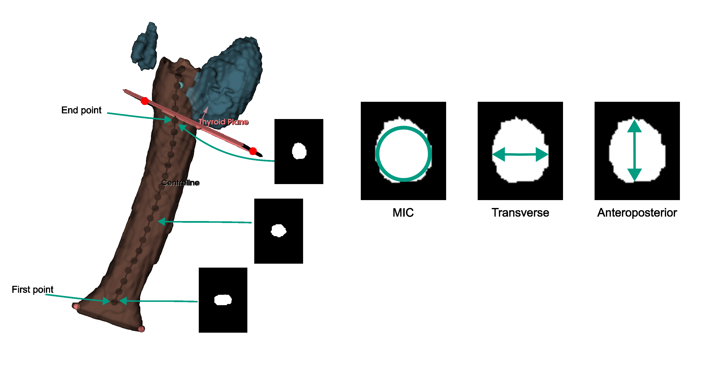 Segmented trachea with centerline fitted